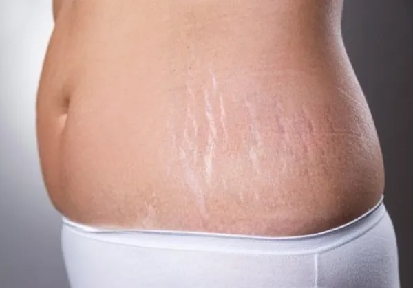 kem Bio Oil trị rạn da cho b&agrave; bầu