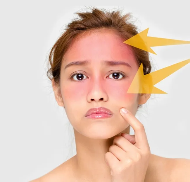 Dị ứng kem chống nắng