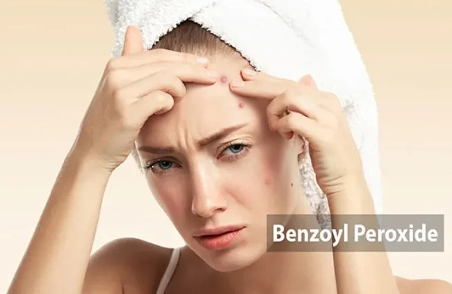 Benzoyl peroxide hỗ trợ điều trị mụn trứng c&aacute; hiệu quả