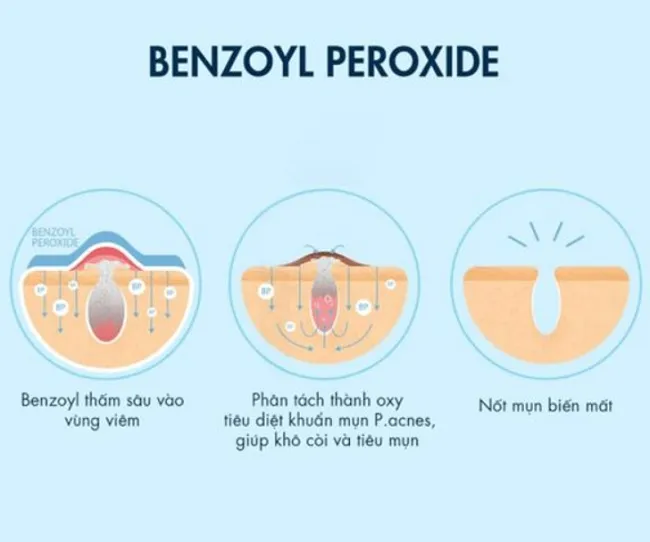 Benzoyl peroxide l&agrave; g&igrave;