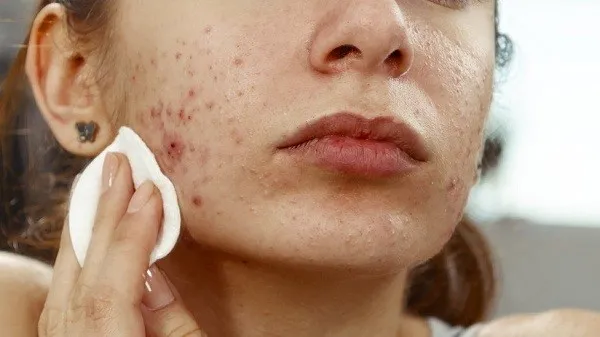Nguy&ecirc;n nh&acirc;n g&acirc;y mụn do vệ sinh kh&ocirc;ng sạch
