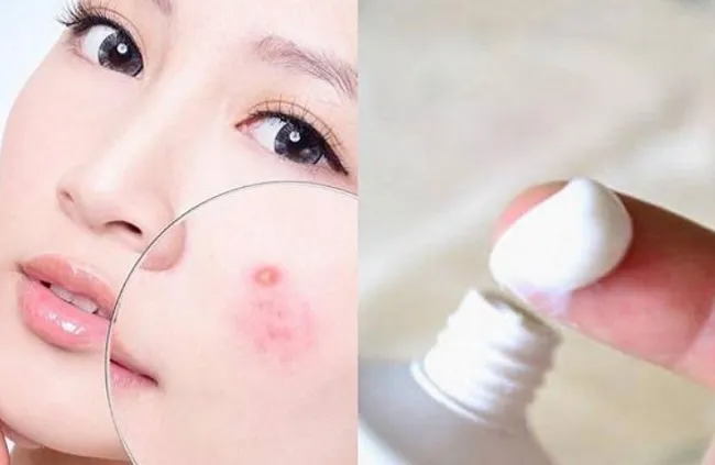 C&aacute;ch sử dụng benzoyl peroxide