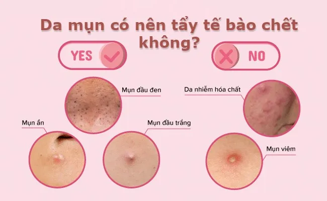 Da mụn c&oacute; n&ecirc;n tẩy tế b&agrave;o chết kh&ocirc;ng? N&ecirc;n - kh&ocirc;ng n&ecirc;n