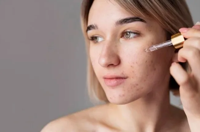 Lactic acid gi&uacute;p ngăn ngừa v&agrave; cải thiện mụn trứng c&aacute;