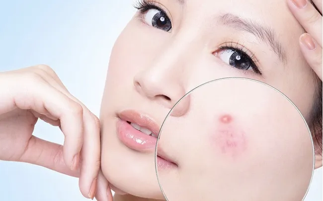 Salicylic acid tốt cho da dầu mụn