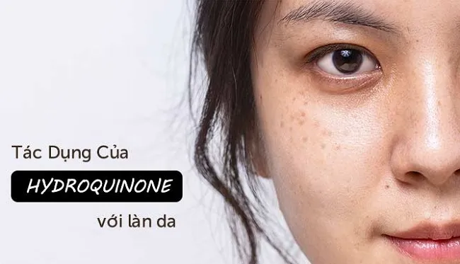 Hydroquinone c&oacute; ưu điểm g&igrave;