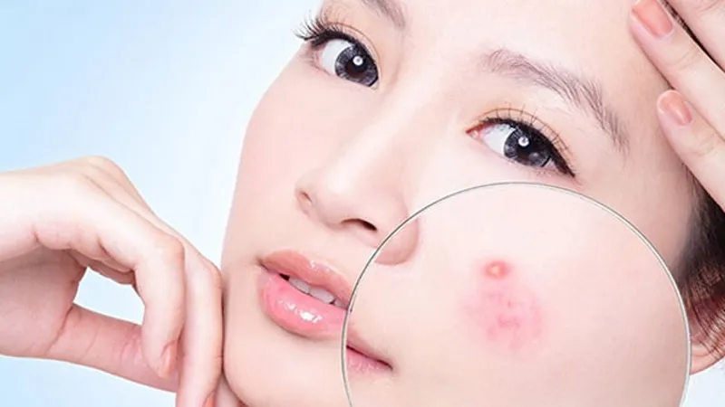 Uống collagen kh&ocirc;ng trực tiếp g&acirc;y n&oacute;ng hoặc nổi mụn