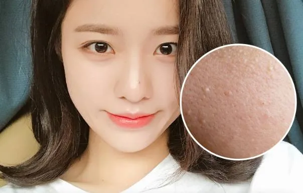 ưu &dstrok;iểm của nước tẩy trang giảm tắc nghẽn lỗ ch&acirc;n l&ocirc;ng