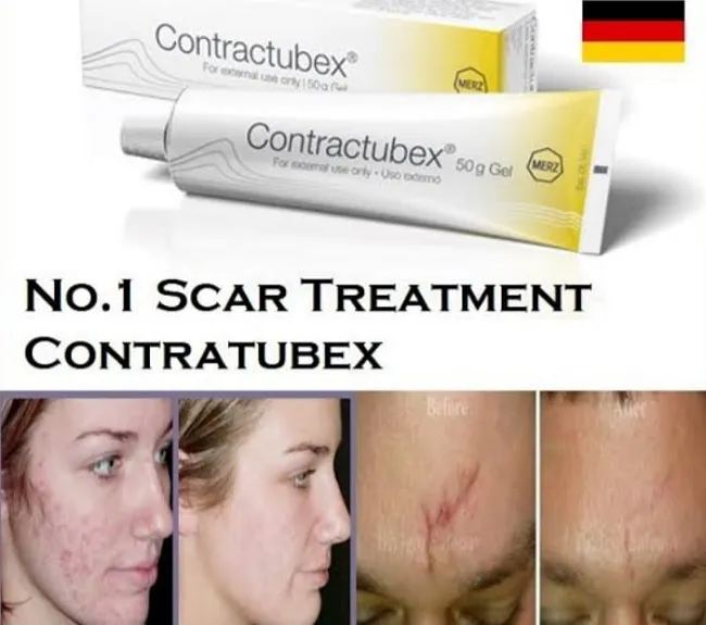 Review kem trị sẹo Contractubex c&oacute; tốt kh&ocirc;ng