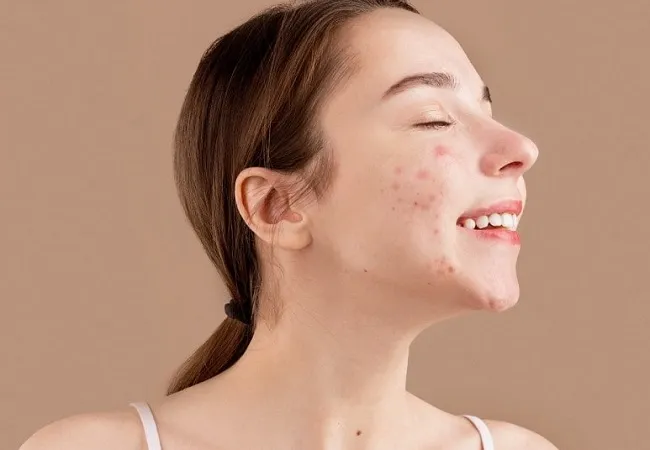 PHA gi&uacute;p trị mụn trứng c&aacute;
