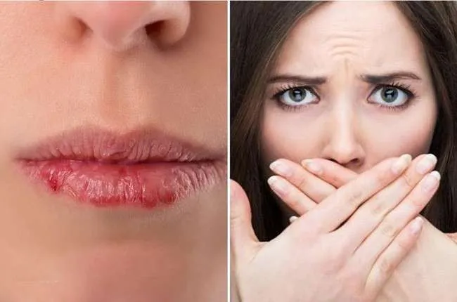 M&ocirc;i c&oacute; vết thương hở kh&ocirc;ng n&ecirc;n sử dụng tẩy tế b&agrave;o chết m&ocirc;i