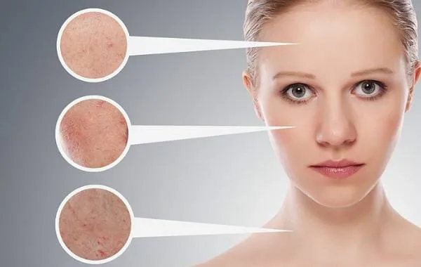 Tẩy tế b&agrave;o chết BHA c&oacute; gi&uacute;p l&agrave;m sạch mụn kh&ocirc;ng?