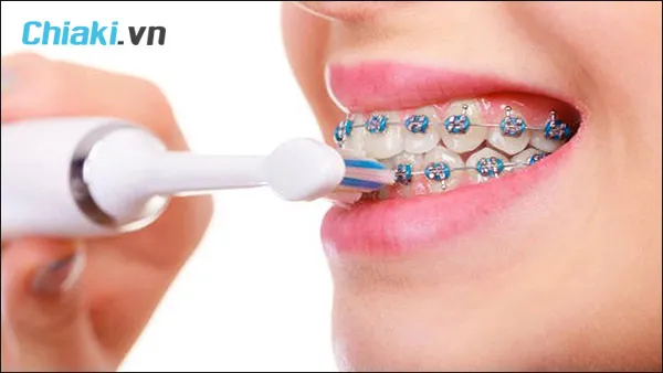 niềng răng c&oacute; n&ecirc;n d&ugrave;ng b&agrave;n chải điện
