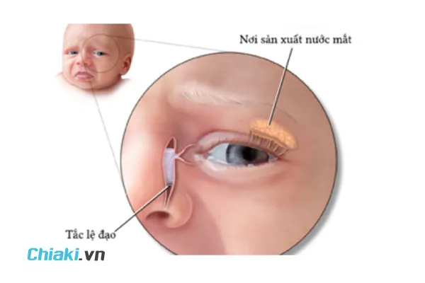 Có Nên Dùng Thuốc Nhỏ Mắt Chữa Tắc Tuyến Lệ Cho Trẻ Nhỏ Không?