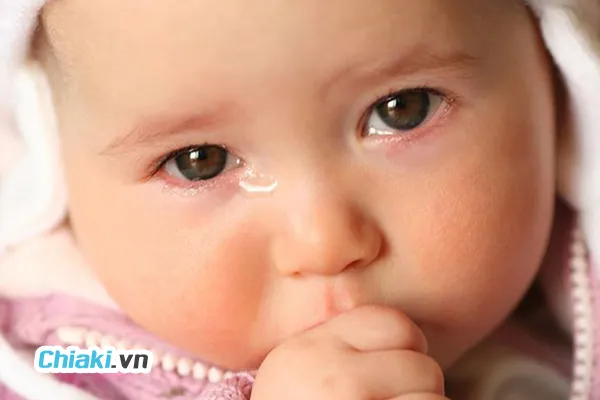 Tắc tuyến lệ khiến nước mắt kh&ocirc;ng thể dẫn lưu một c&aacute;ch b&igrave;nh thường