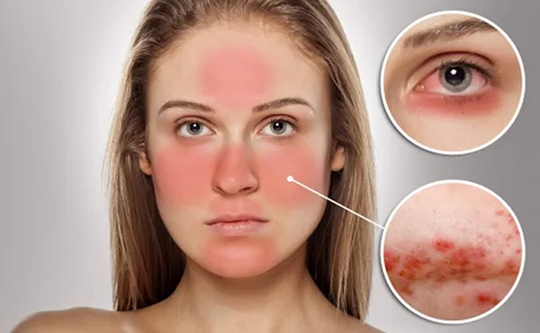 Nguy&ecirc;n nh&acirc;n bị dị ứng kem chống nắng