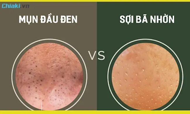 Sợi b&atilde; nhờn mũi kh&aacute;c mụn đầu đen