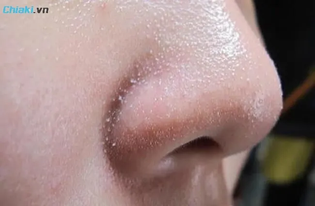Sợi b&atilde; nhờn ở mũi l&agrave; một phần của l&agrave;n da, ch&uacute;ng được tạo n&ecirc;n nhờ v&agrave;o c&aacute;c tuyến b&atilde; nhờn, lipid b&atilde; nhờn, vi khuẩn v&agrave; cả c&aacute;c tế b&agrave;o chết