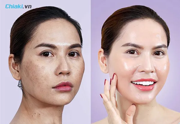 ưu nhược điểm của phương ph&aacute;p cấy trắng da mặt