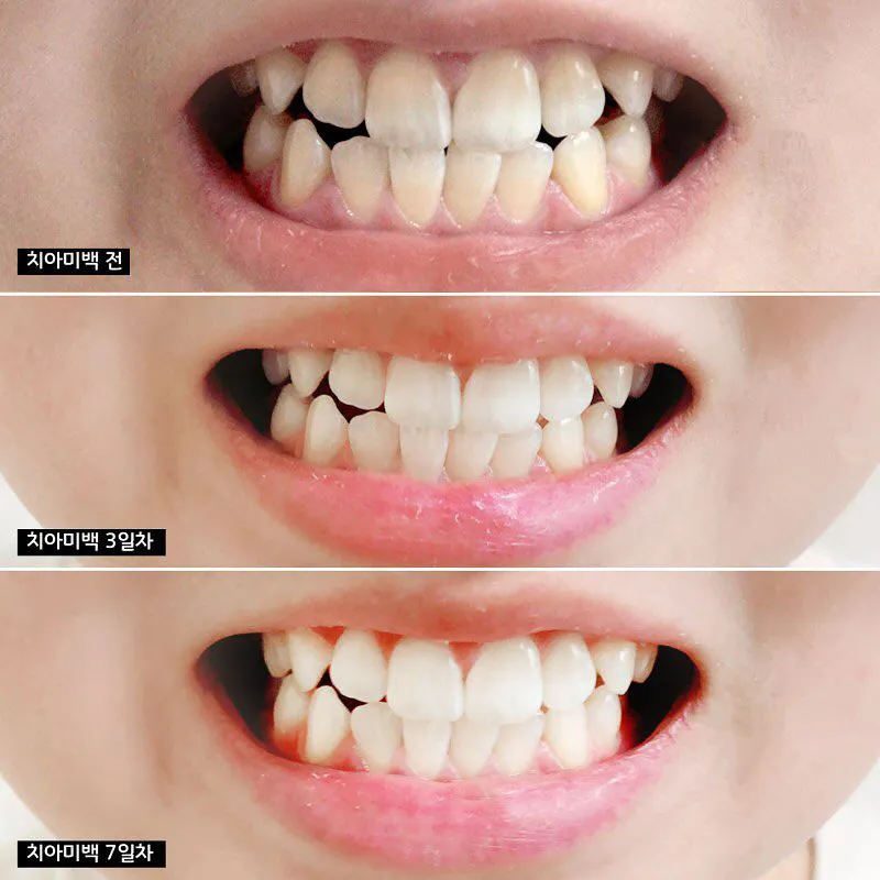 C&aacute;ch sử dụng kem đ&aacute;nh răng H&agrave;n Quốc như thế n&agrave;o?