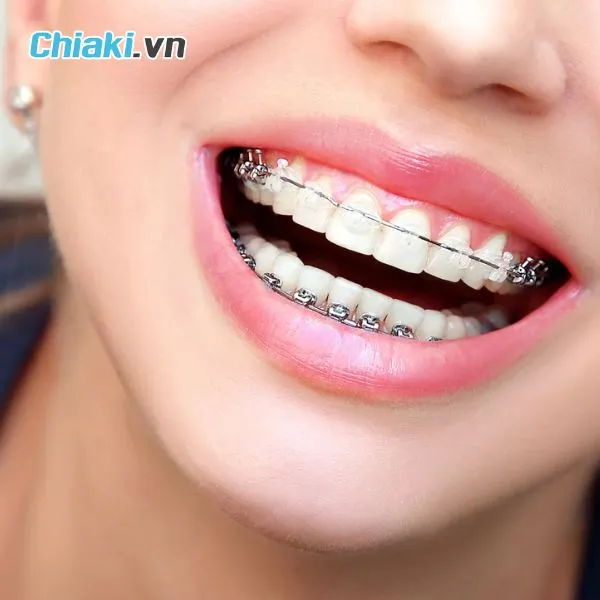 Lợi &iacute;ch khi sử dụng nước s&uacute;c miệng cho người niềng răng