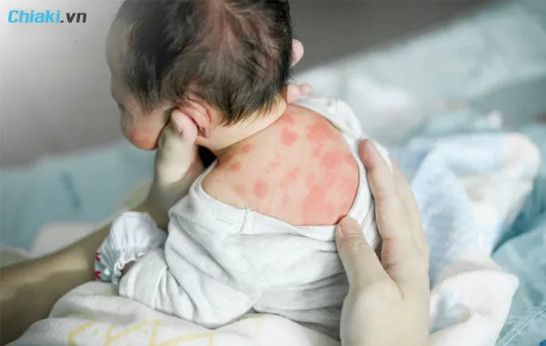 N&ecirc;n đổi sữa khi trẻ bị ti&ecirc;u chảy, buồn n&ocirc;n v&agrave; nổi ban