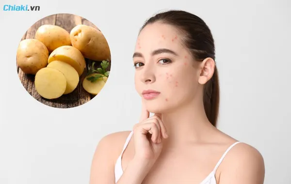 mặt nạ lột mụn bằng khoai t&acirc;y
