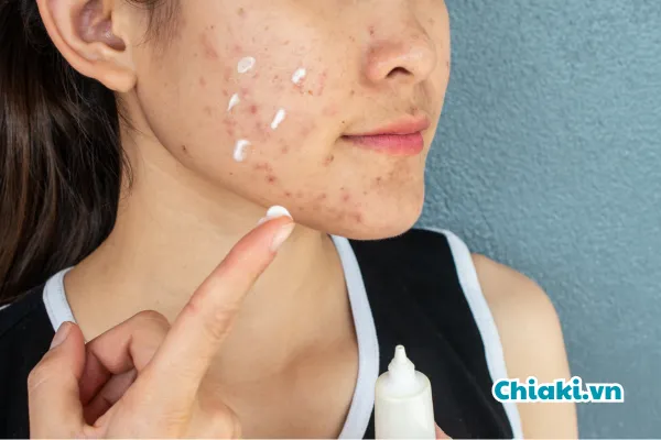 ưu điểm của kem trị mụn
