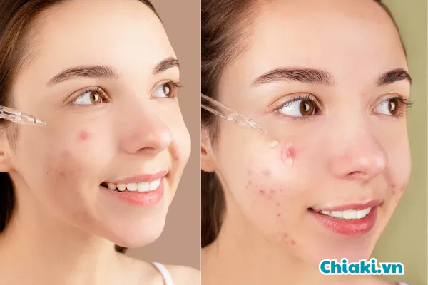 N&ecirc;n b&ocirc;i kem trị mụn trước hay sau serum?
