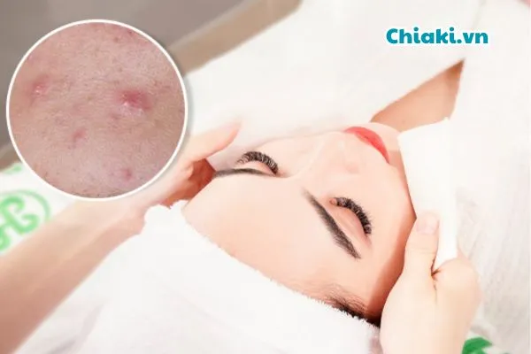 C&aacute;ch chăm s&oacute;c da ngừa mụn đầu đen