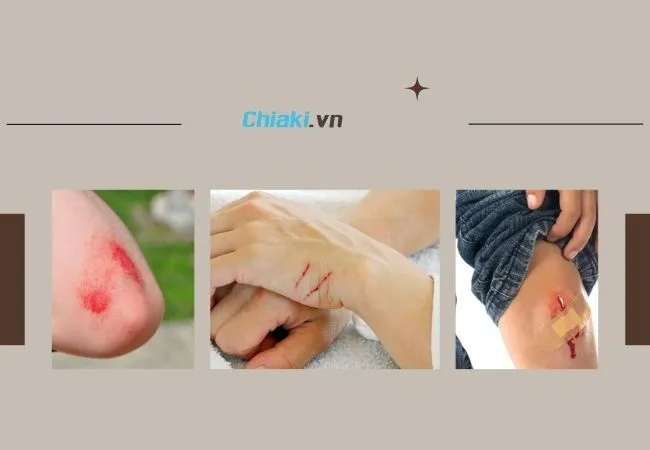 Nguy&ecirc;n nh&acirc;n khiến da bị trầy xước