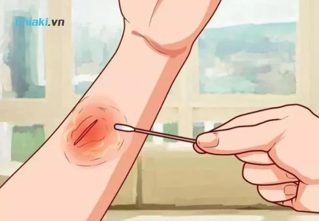 C&aacute;ch xử l&yacute; vết thương tr&aacute;nh để lại sẹo