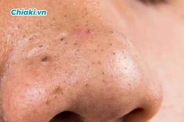 Nguy&ecirc;n nh&acirc;n bị mụn đen