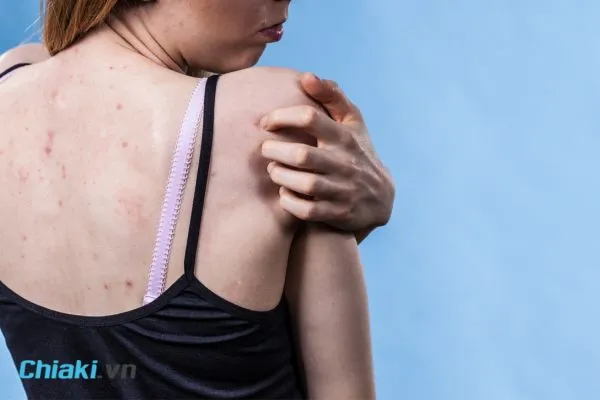 Nguy&ecirc;n nh&acirc;n bị mụn lưng l&agrave; g&igrave;?