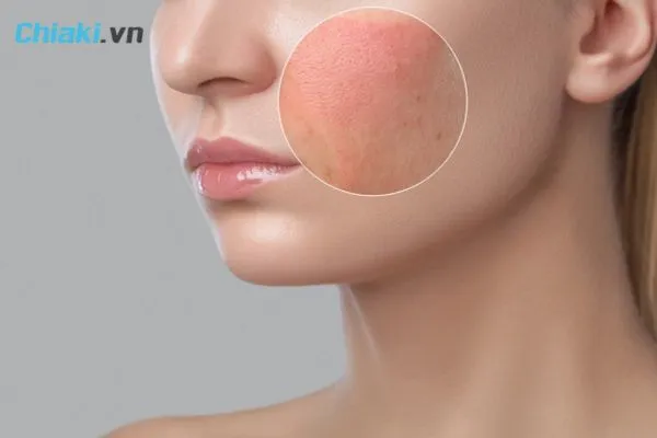C&aacute;c vấn đề gặp phải sau khi t&aacute;i tạo da