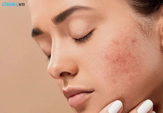 retinol cho da kh&ocirc; c&oacute; thể g&acirc;y ch&acirc;m ch&iacute;ch, đỏ r&aacute;t