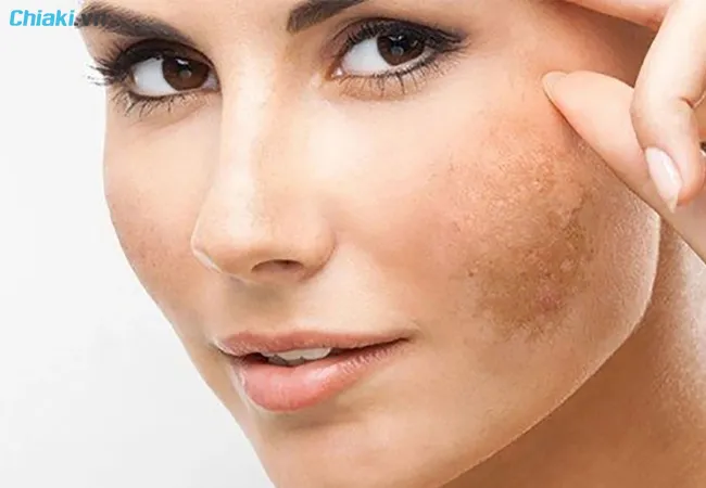 retinol cho da kh&ocirc; khi sử dụng c&oacute; thể g&acirc;y sạm