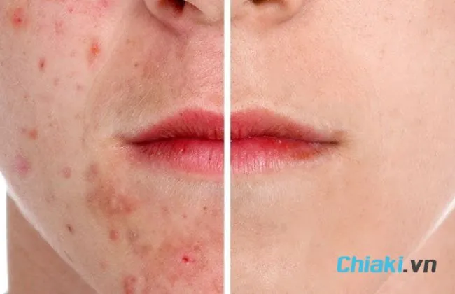 Glycolic Acid trị mụn trứng c&aacute;