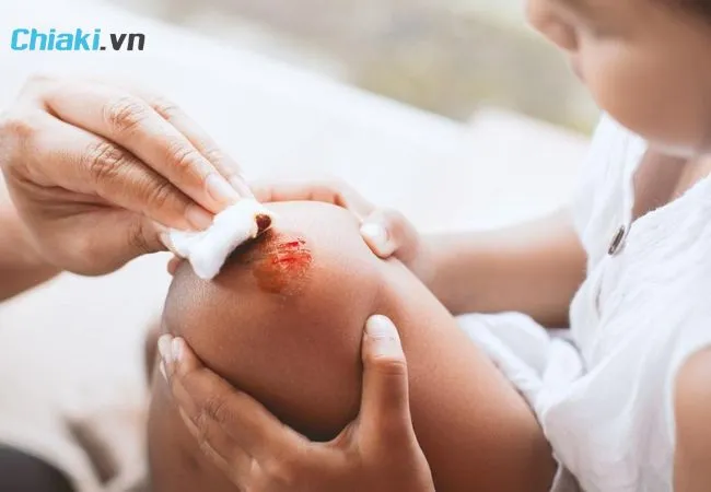 C&aacute;ch sơ cứu vết thương