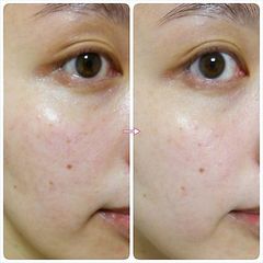 Serum Fracora Placenta Extract 30ml - Tinh Chất Nhau Thai Cừu Giúp Làm Sáng Da, Se Khít Lỗ Chân Lông, Cải Thiện Nếp Nhăn