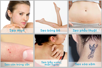 Kem hỗ trợ mờ sẹo Scar Rejuvasil 10ml - Giải pháp trị sẹo lồi, phẫu thuật và vết rạn da hiệu quả từ Mỹ