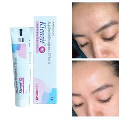 Gel Trị Mụn Klenzit MS 15g - Hỗ Trợ Giảm Mụn Trứng Cá và Mụn Ẩn, Làm Sáng Da và Ngăn Ngừa Viêm, Chính Hãng Glenmark