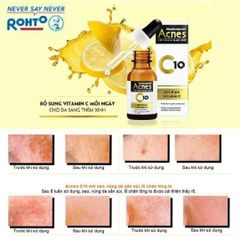 Serum Acnes Vitamin C 15ml - Tinh Chất Làm Mờ Sẹo & Vết Thâm - Giải Pháp Cho Da Sáng Mịn Màng, Đánh Bật Sẹo Mụn
