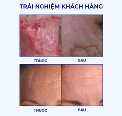Miếng Dán Mờ Sẹo Lồi Rejuvaskin Scar FX - Dán Silicon Chuyên Dụng Hỗ Trợ Làm Mờ Sẹo Hiệu Quả, An Toàn Cho Da