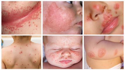Combo 3 Nước Tắm Cho Bé Dr Baby Giảm Rôm Sảy, Mẩn Ngứa, Hăm Tã