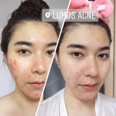 Serum Ngăn Ngừa Mụn Lumos Acne 5ml - Giảm Thâm, Dưỡng Da Sáng Khỏe Mạnh Cho Da Nhạy Cảm, Hỗ Trợ Trị Mụn Tự Nhiên