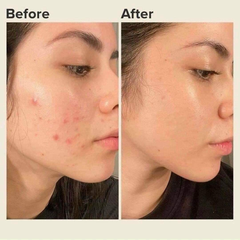 Gel trị mụn ngừa thâm Derma Forte Gamma - Hỗ trợ làm sạch, mờ sẹo, giảm viêm, an toàn cho da nhạy cảm