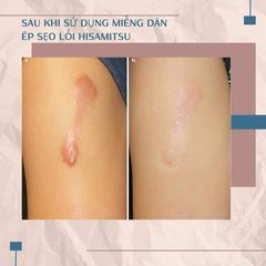 Miếng dán sẹo lồi nội địa Nhật Bản - Hisamitsu