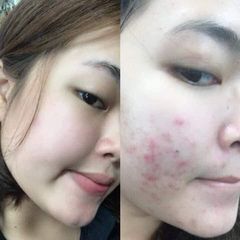 Kem mụn nội địa Hàn Quốc Pair Acne - Lion