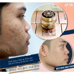 Kem Trị Sẹo Rỗ Genie Non Fix Skin Hàn Quốc - Hỗ Trợ Cải Thiện Sẹo, Kháng Viêm, Phục Hồi Da Tổn Thương